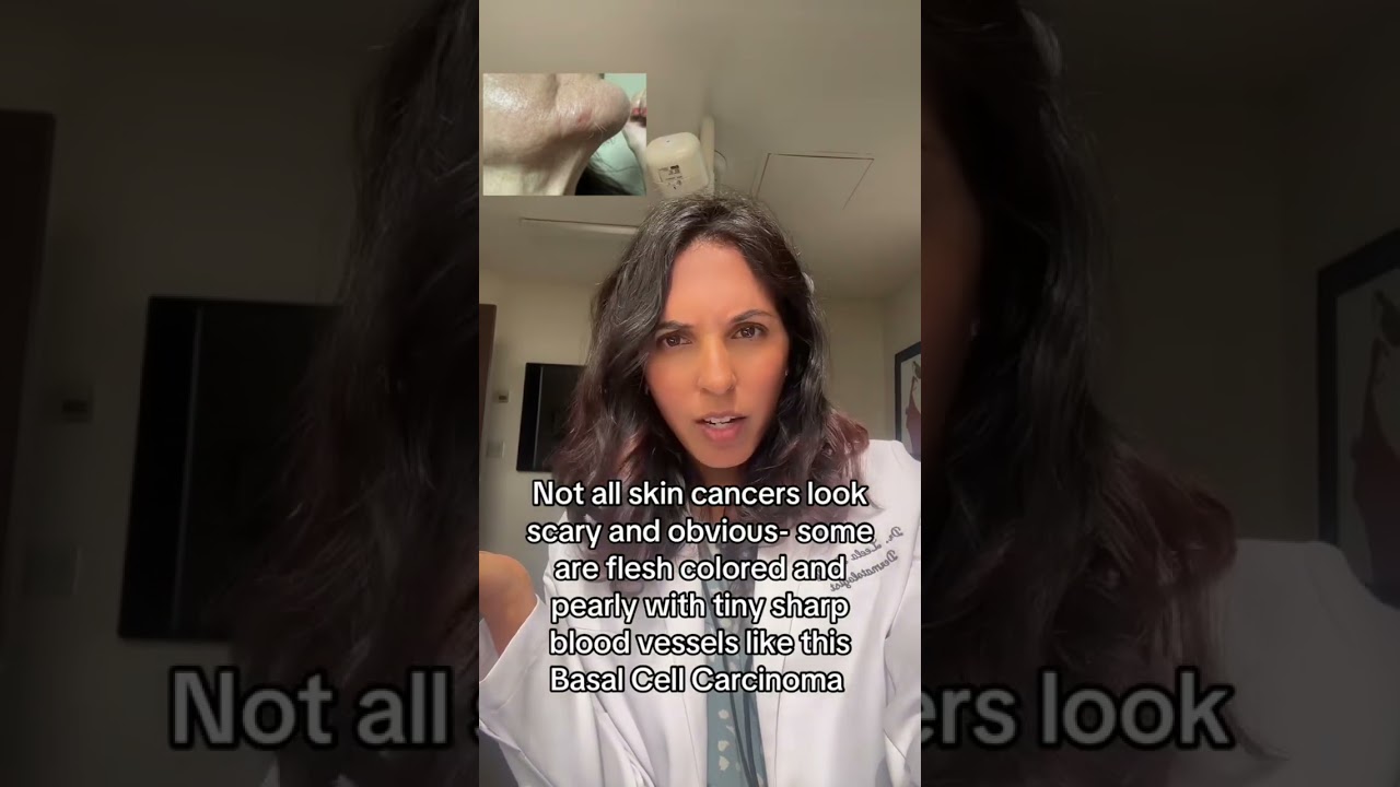 e Skin Cancer You May Miss: Basal Cell Carcinoma  #basalcellcarcinoma #skincancer #dermatologist