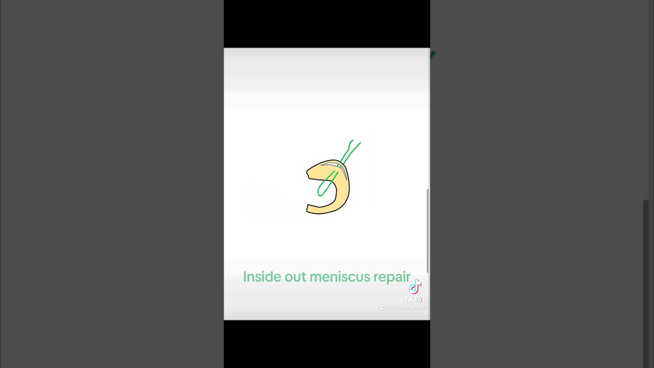 Inside out #meniscus repair ! #orthopedics #medtwitter #knee #kneeinjury #kneesurgey
