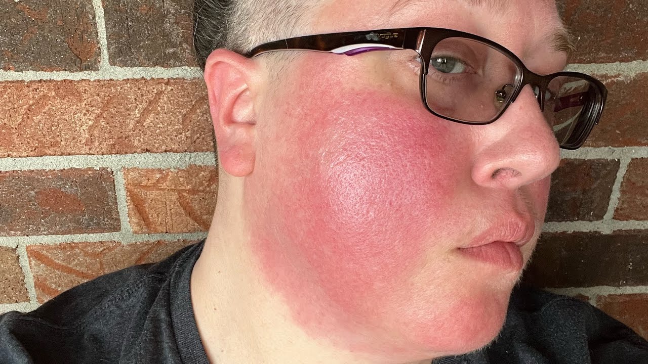 Video 14 - Reality Check: Living on Fire with Erythromelalgia & Anhidrosis.