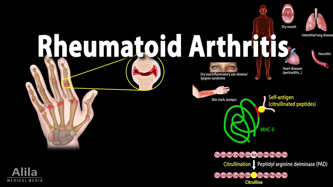 Ревматоидный артрит, анимация