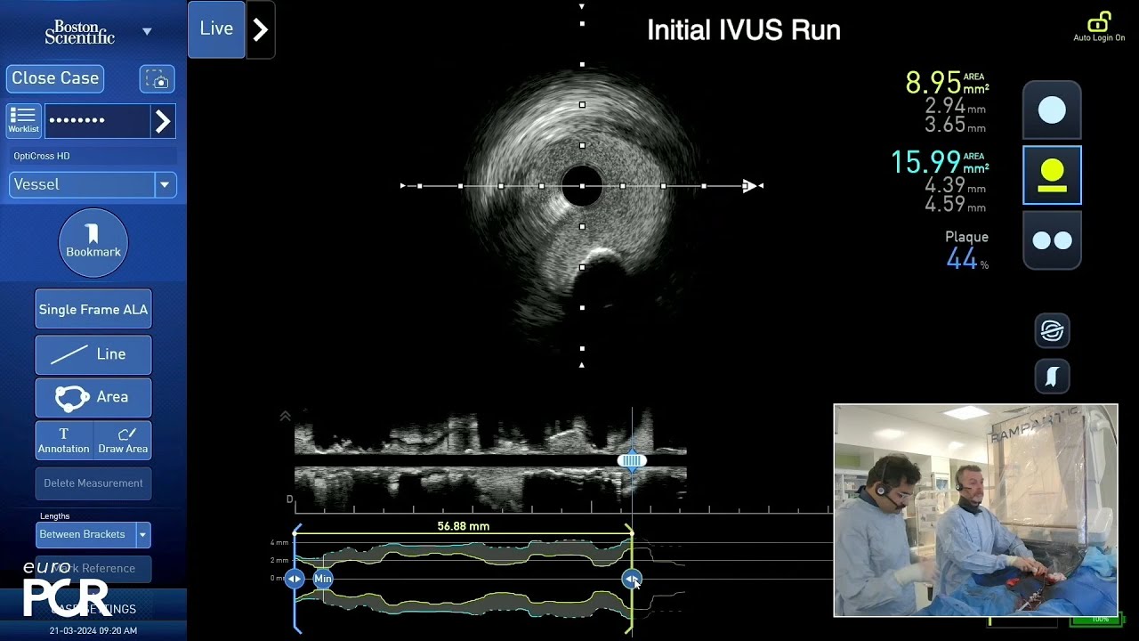 A new horizon in IVUS-guided PCI of calcified stenoses with artificial intelligence