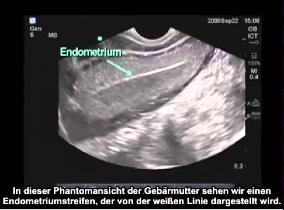 Anleitung: Transvaginale Ultraschalluntersuchung