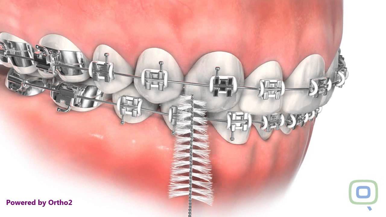 Oral Hygiene with Braces