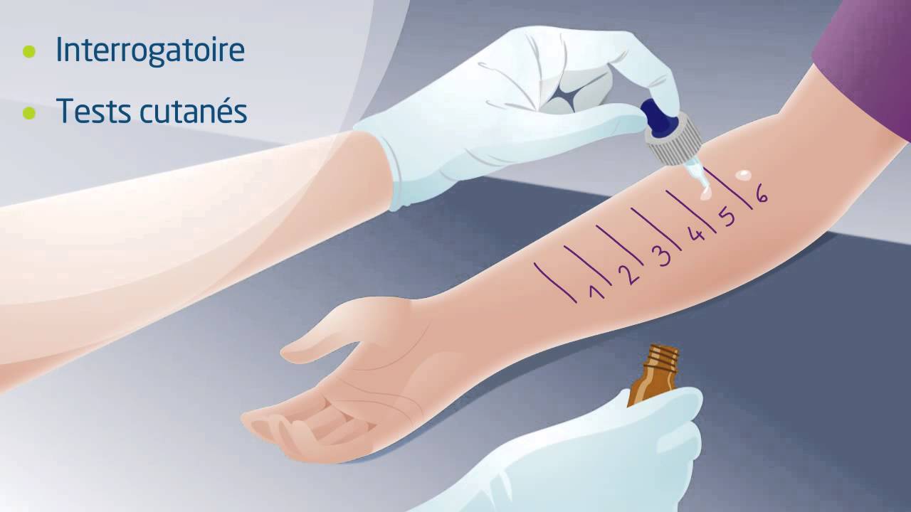Qu'est-ce que l'immunothérapie allergénique ?