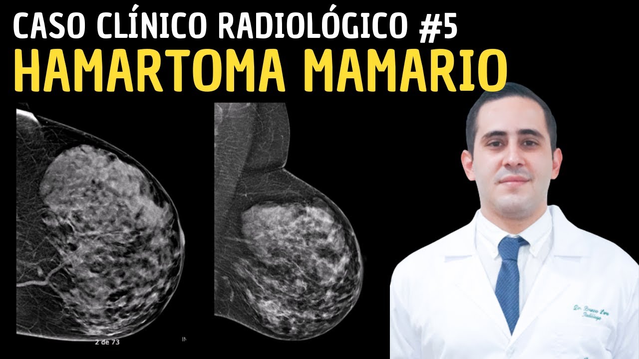 Hamartoma Mamario: Caso Clínico Radiológico.