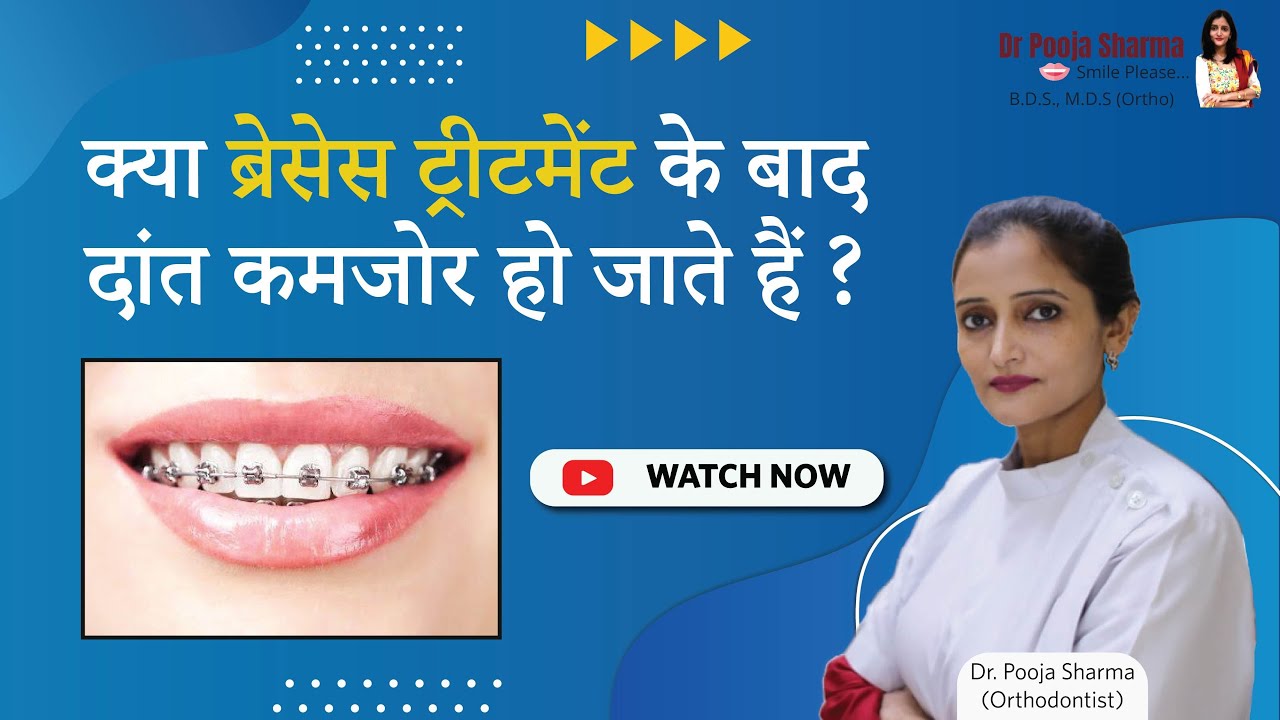 Do Teeth Get Weak After Braces Treatment? Teeth Braces Treatment in Agra, India - Dr Pooja Sharma
