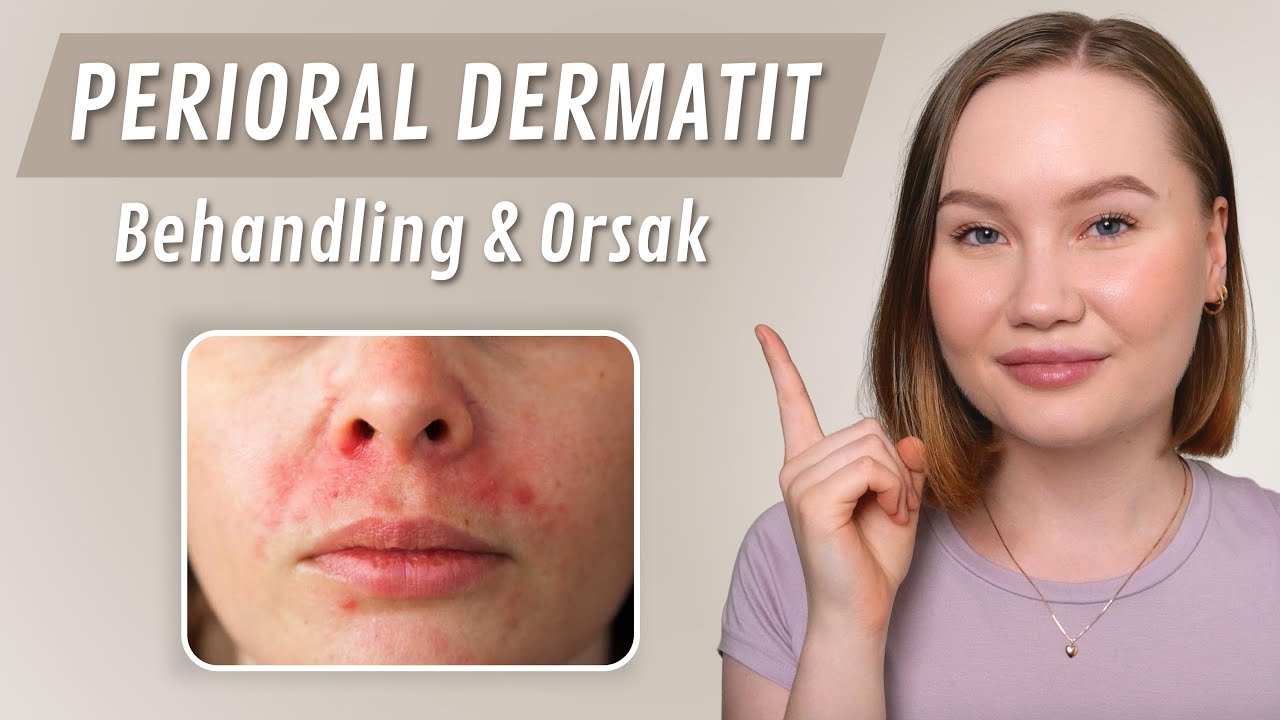 Bli av med Perioral Dermatit SNABBT