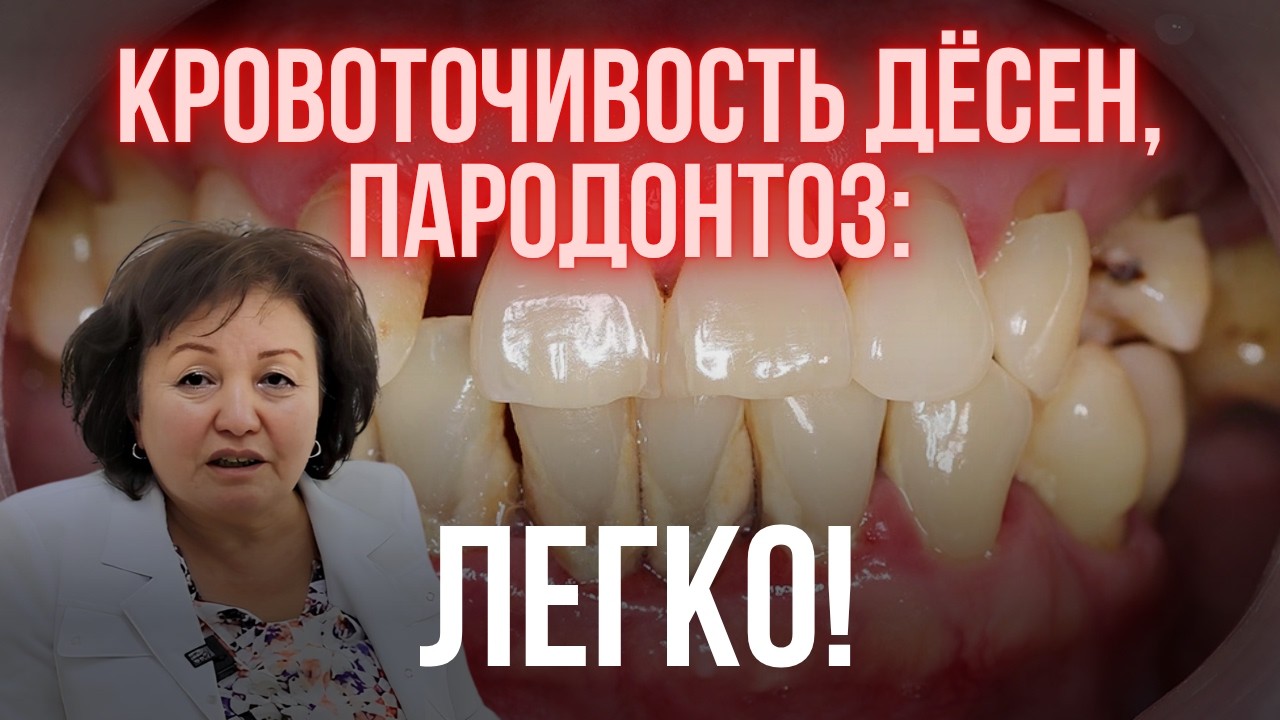 КРОВОТОЧИВОСТЬ ДЁСЕН, ПАРОДОНТОЗ: ЛЕГКО!
