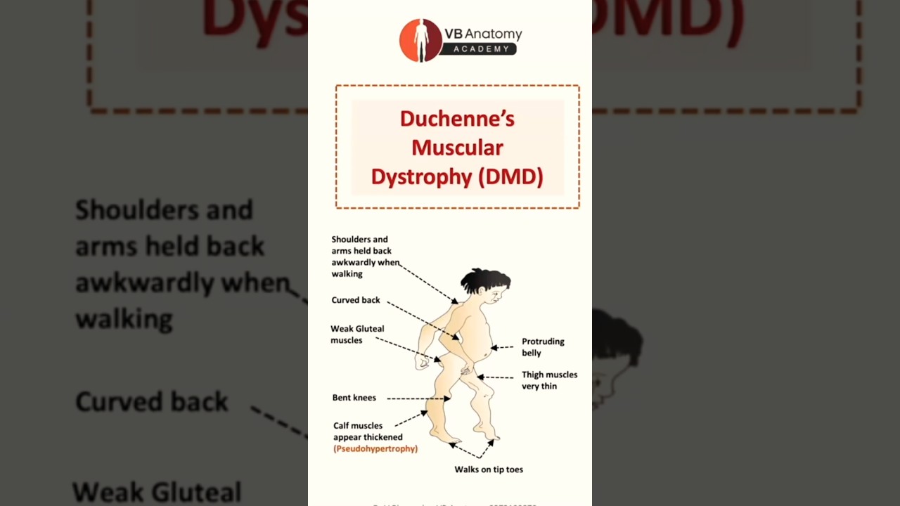Duchenne Muscular Dystrophy (DMD) Explained: Symptoms, Causes, and Disease Progression