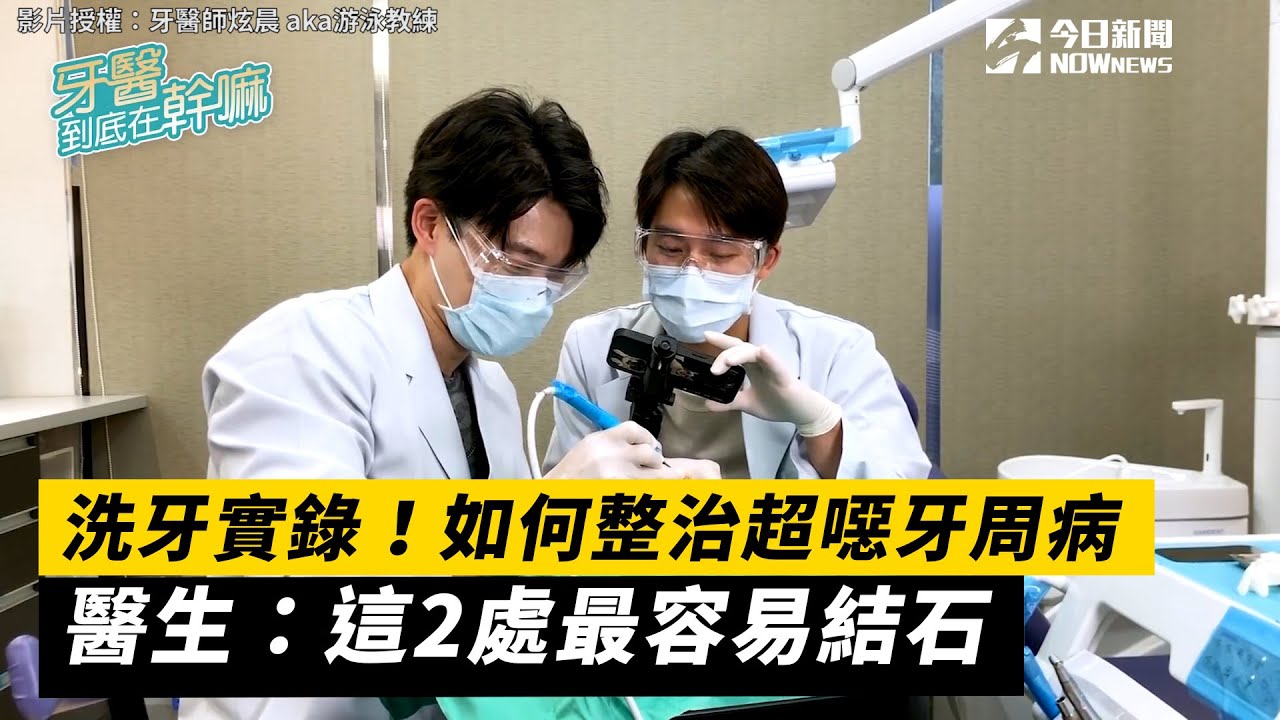 洗牙實錄！如何整治超噁牙周病  醫生：這2處最容易結石｜小編特搜｜NOWnews