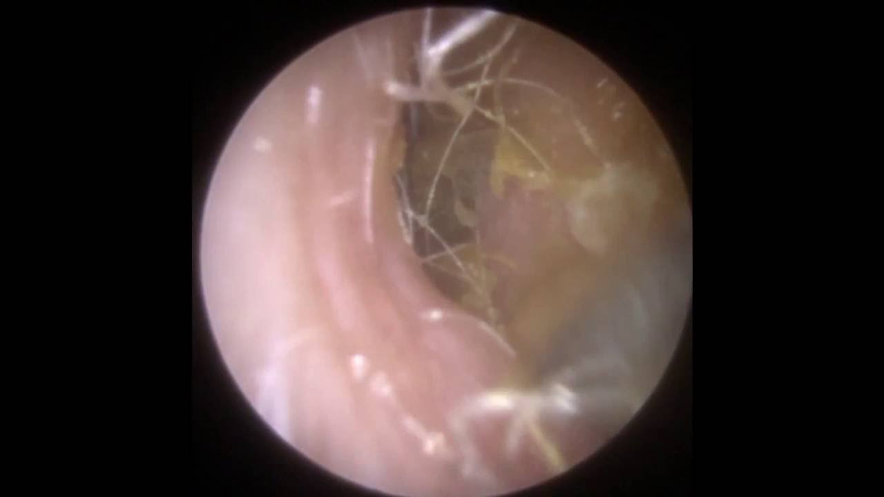 Endoscopic Removal of Soft Ear Wax - Mr Neel Raithatha (The Hear Clinic - Leicester)