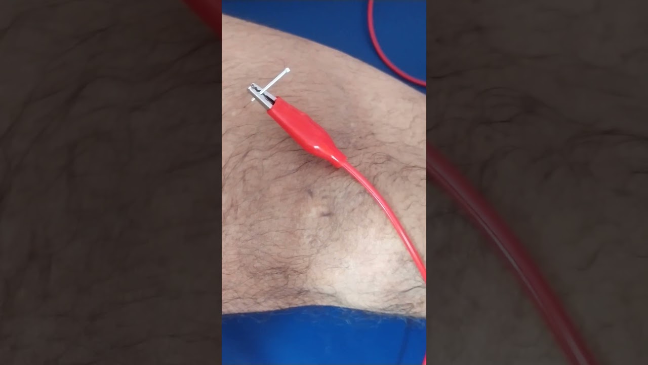 Arthritis Joint Pain Treatment by Acupuncture tens