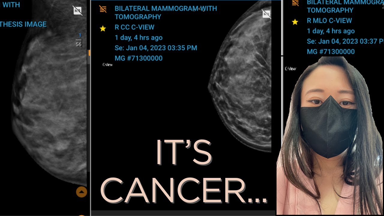 Breast cancer diagnosis story | Misdiagnosed | Mammogram + ultrasound | biopsy
