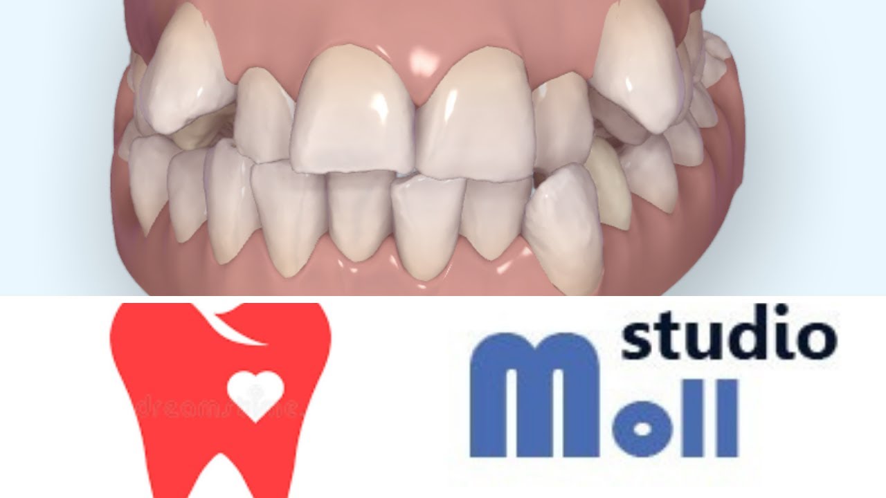 INVISALIGN :  Grave affollamento, una sfida ortodontica risolta in 18 mesi