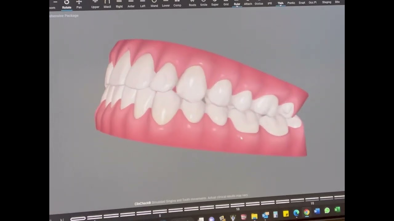 Invisalign 3D virtual treatment simulation