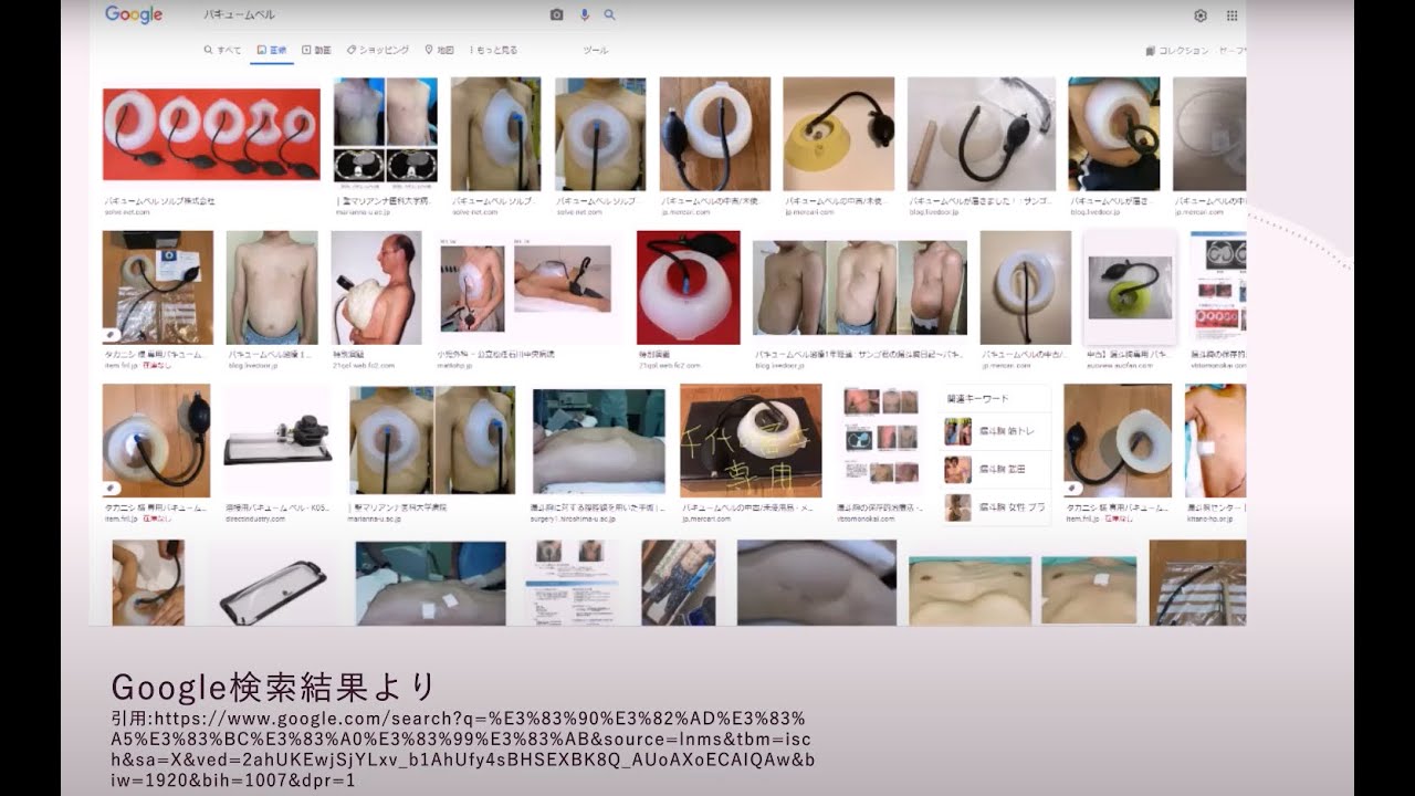 手術しないで漏斗胸は治るのか？（バキュームベルについて）