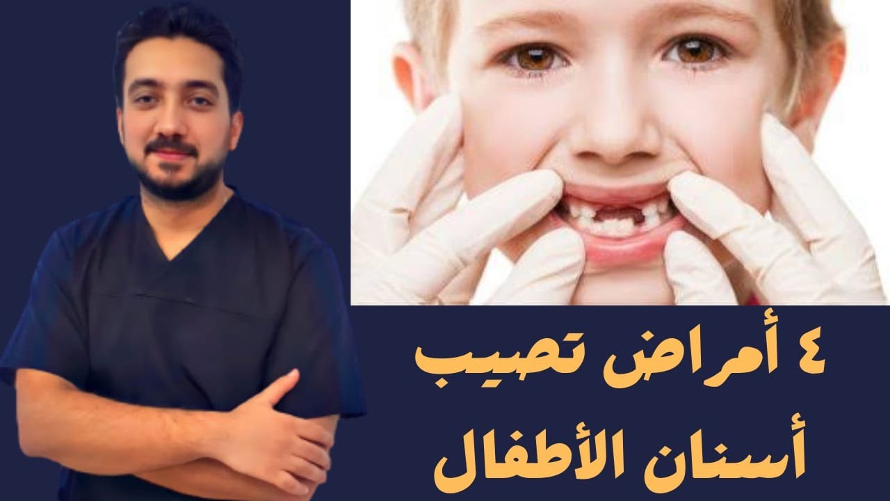 4 أمراض شائعة تصيب أسنان الأطفال