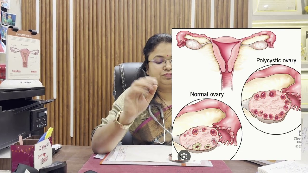 प्रेगनेंसी का बार-बार ख़राब होना#recurrent pregnancy loss#causes#blighted ovum #miscarriage 