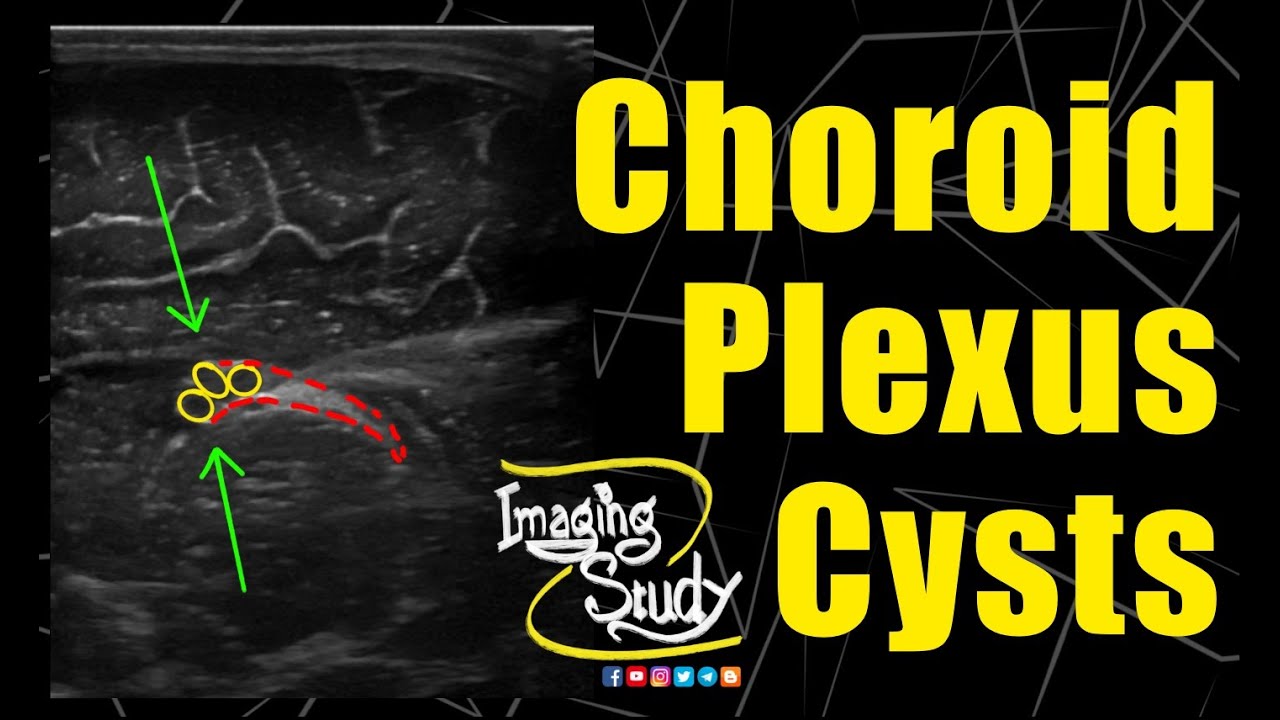 Choroid Plexus Cysts || Neonate || Ultrasound || Case 253