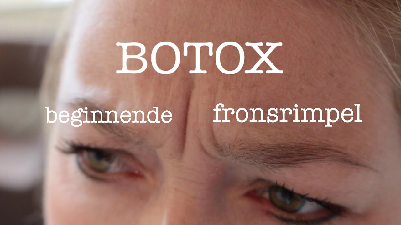 Botox bij beginnende fronsrimpel | FURROW.NL