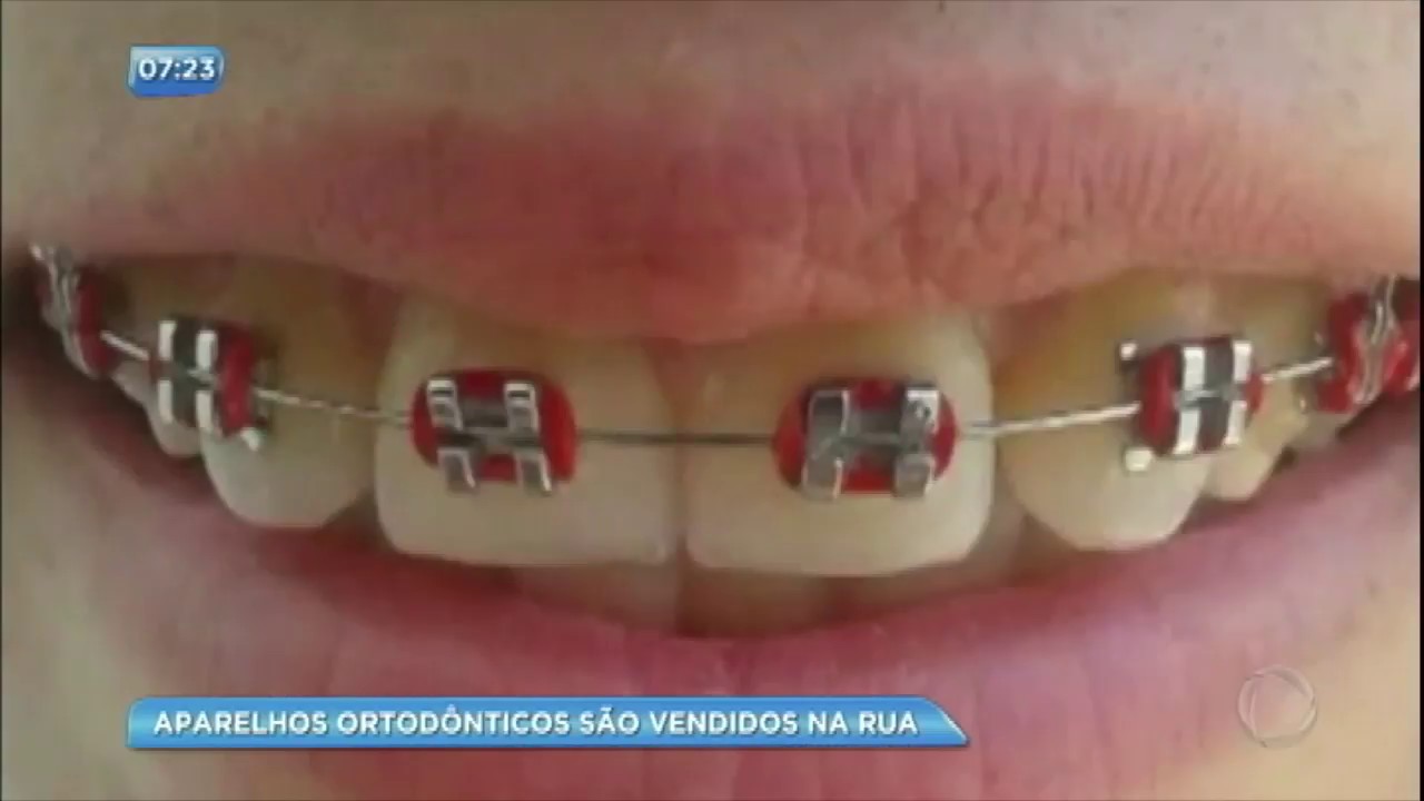 Moda entre jovens, aparelhos ortodônticos são vendidos na rua como 