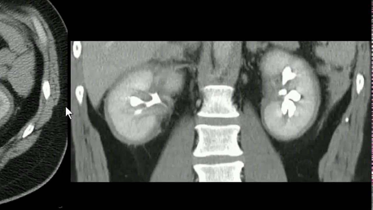 Linfangectasia renal