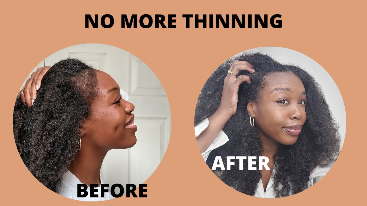 How I Grew Back My Temples | Natural Hair Thinning
