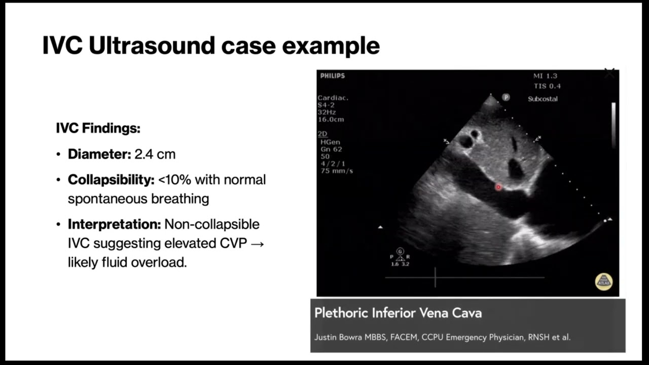 Rethinking the IVC: Limitations in IVC POCUS evaluation of 