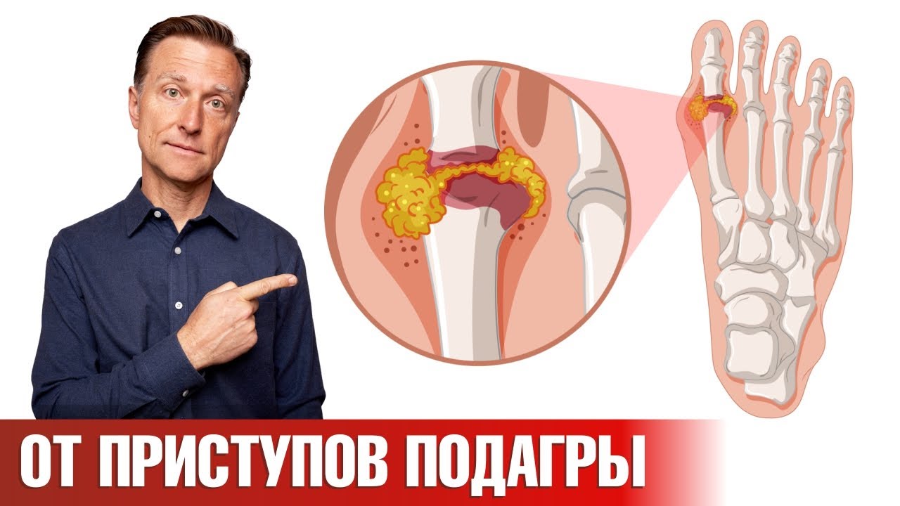 Средство №1 от приступов подагры, которое есть у каждого👍