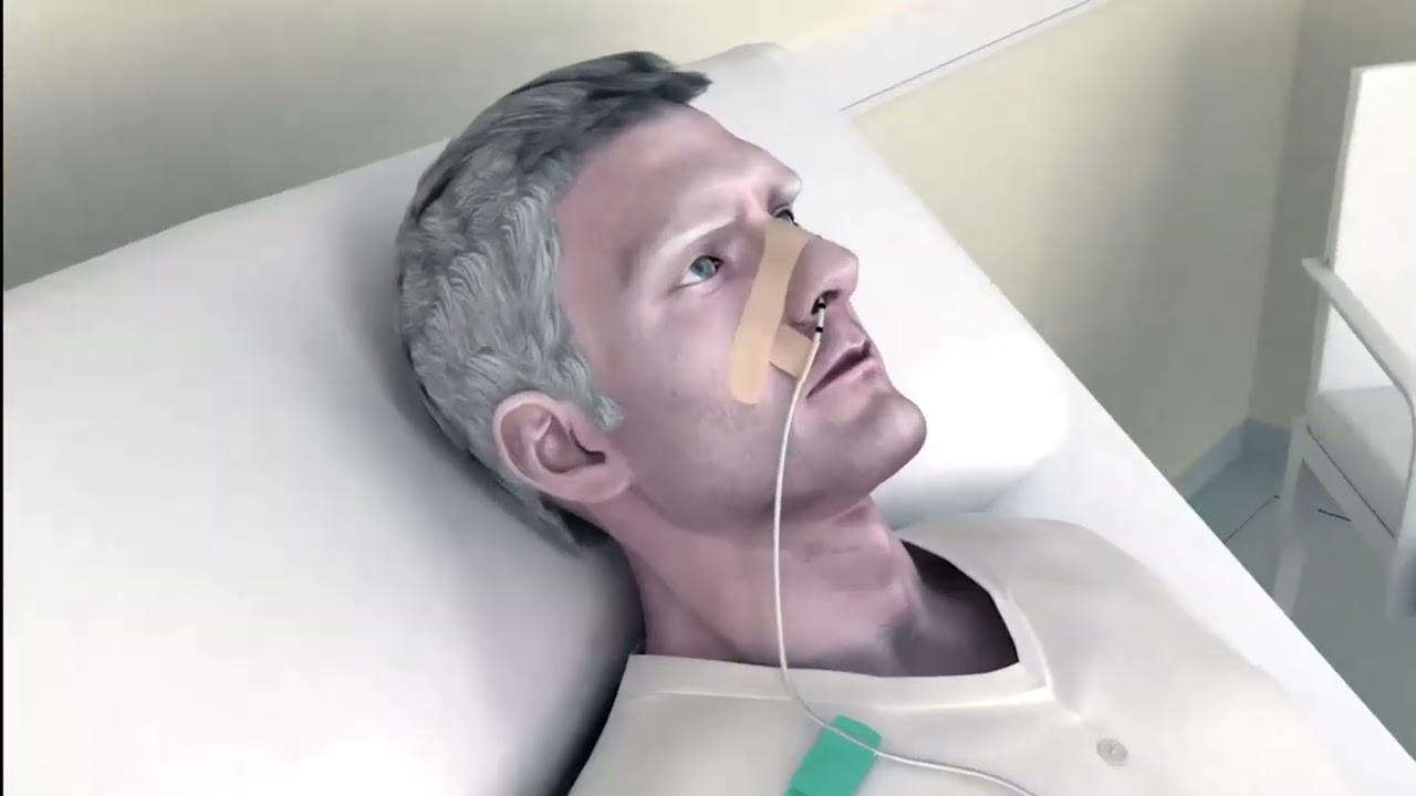 Phagenyx® Neurostimulation for Dysphagia: Len's Story