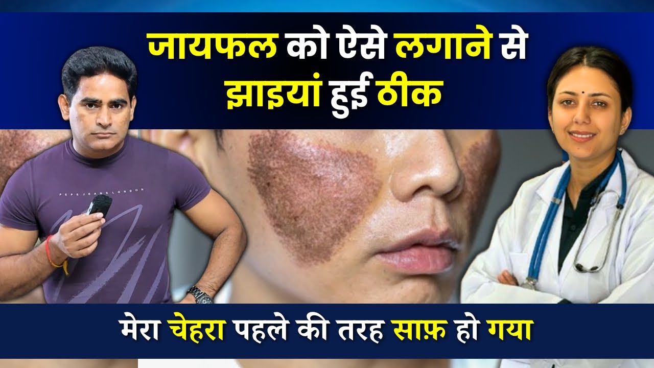 झाइयों के ठीक होने की मैंने उम्मीद छोड़ दी थी | How to Treat Pigmentation in Males | Patient Review