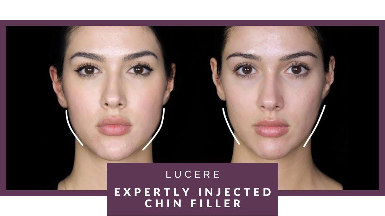 Chin Filler