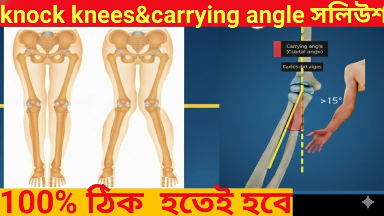 Knock Knee & Carrying Anglee ঠিক করার সহজ উপায় | SSC GD Medical Pass করার সঠিক গাইড