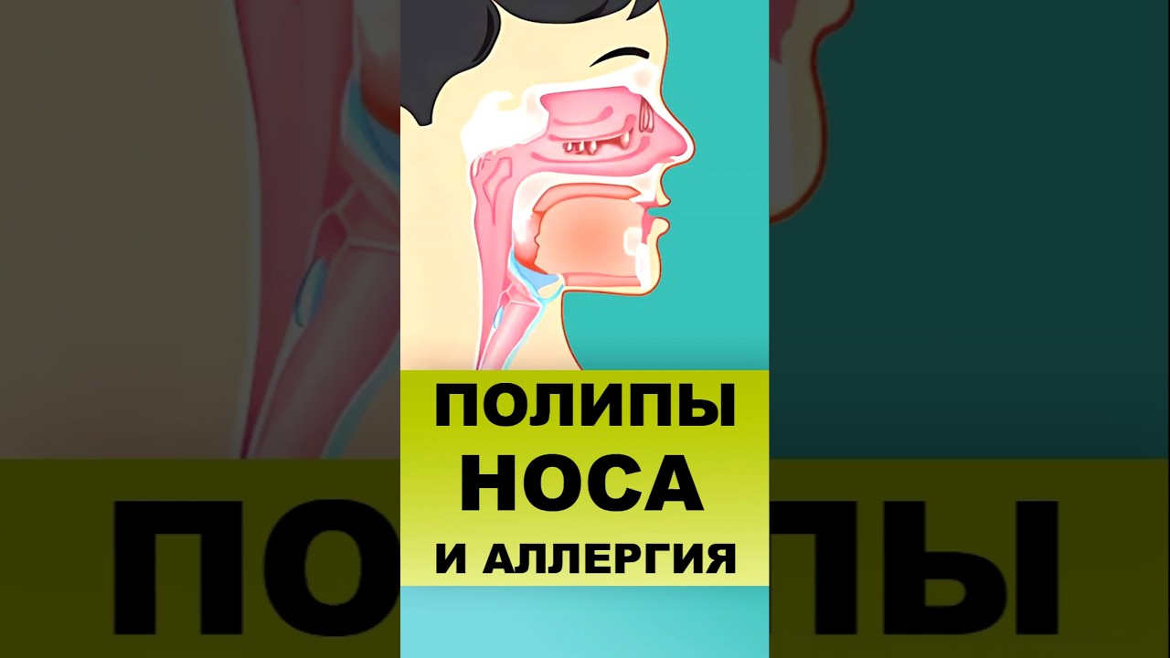 ПОЛИПЫ НОСА И АЛЛЕРГИЯ #полипыноса #полипы #аллергия