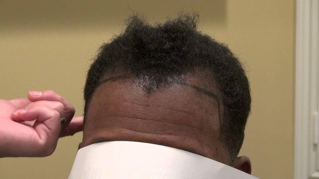 African American Man Receding Corners Hair Loss Transplant Surgery Dr. Diep www.mhtaclinic.com