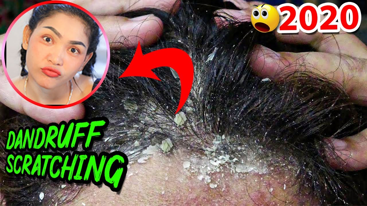 The Most Lazy Girl Never Clean Head Gotten Huge Flake Dandruff Scratching Using Hair Comb
