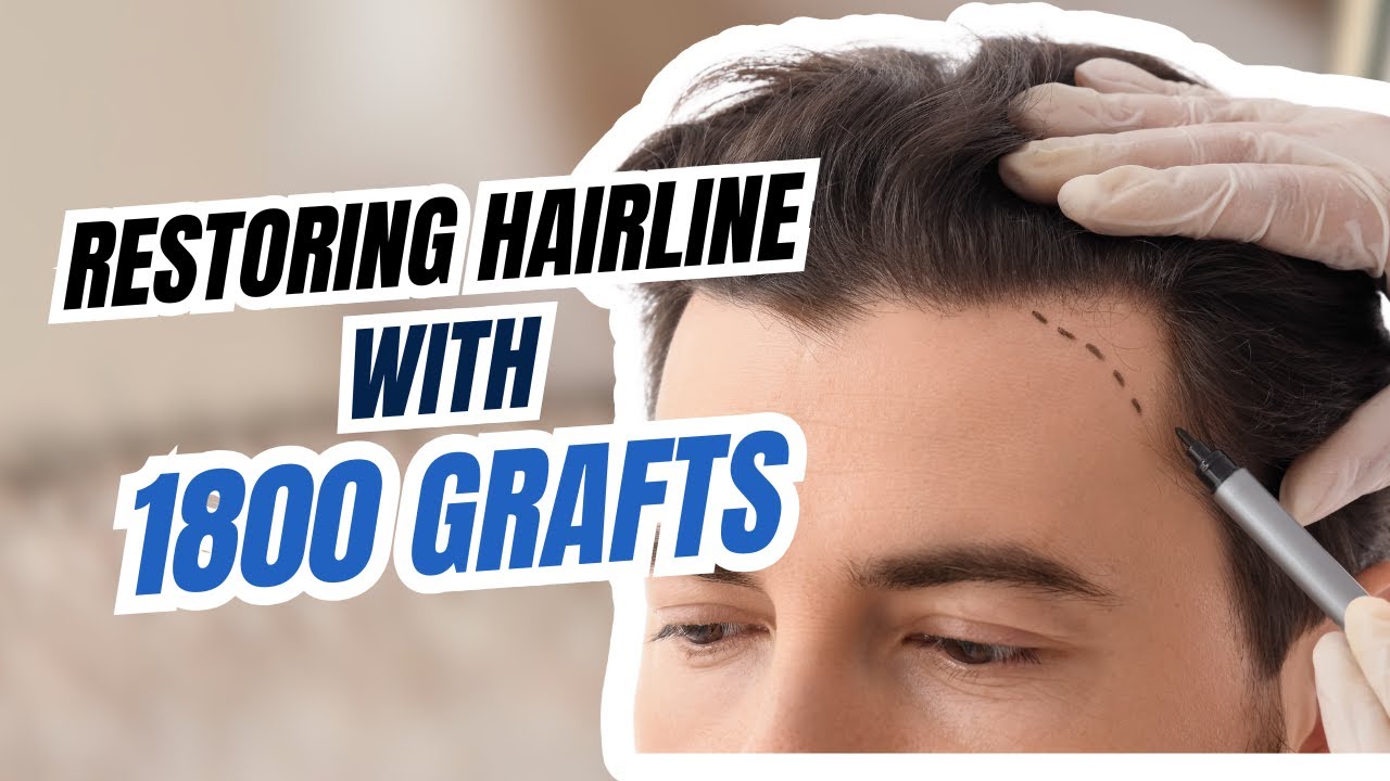 Restoring #hairline with 1800 grafts at @novamedicalhairtransplant