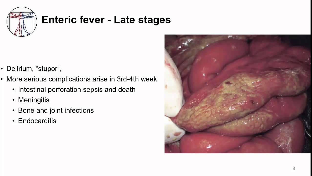 Acute GI: Enteric fever