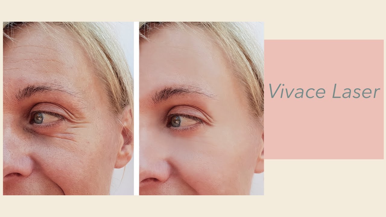 Vivace Laser (mirconeedling & RF)
