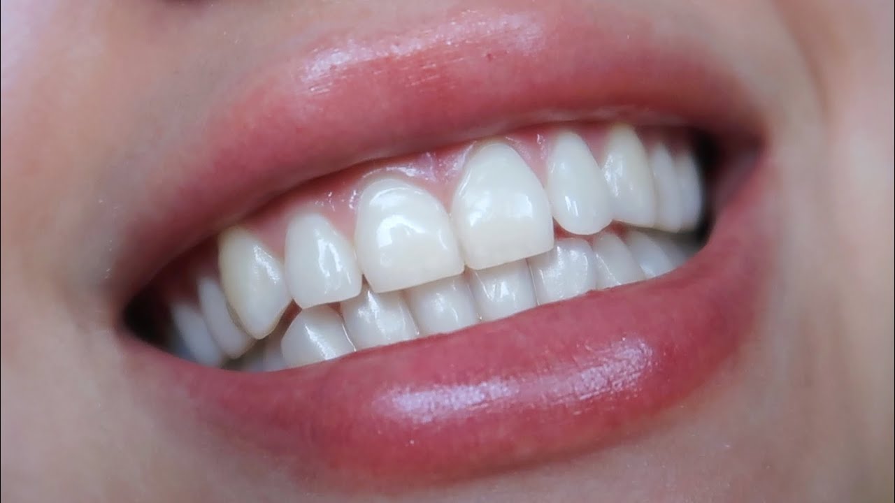 WHITEN YOUR TEETH AT HOME! (w/ before and after pics)