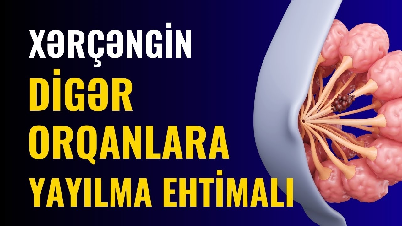 Südvəzi Xərçənginin MƏRHƏLƏLƏRİ | Onkoloq-Mammoloq İndira Səfərova