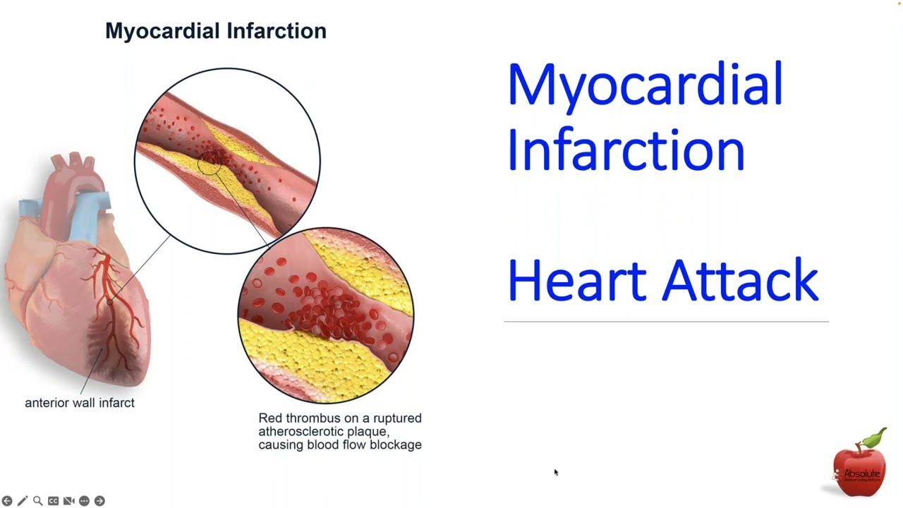 ICD 10 CM coding for a Heart Attack:  STEMI vs NSTEMI for Beginners
