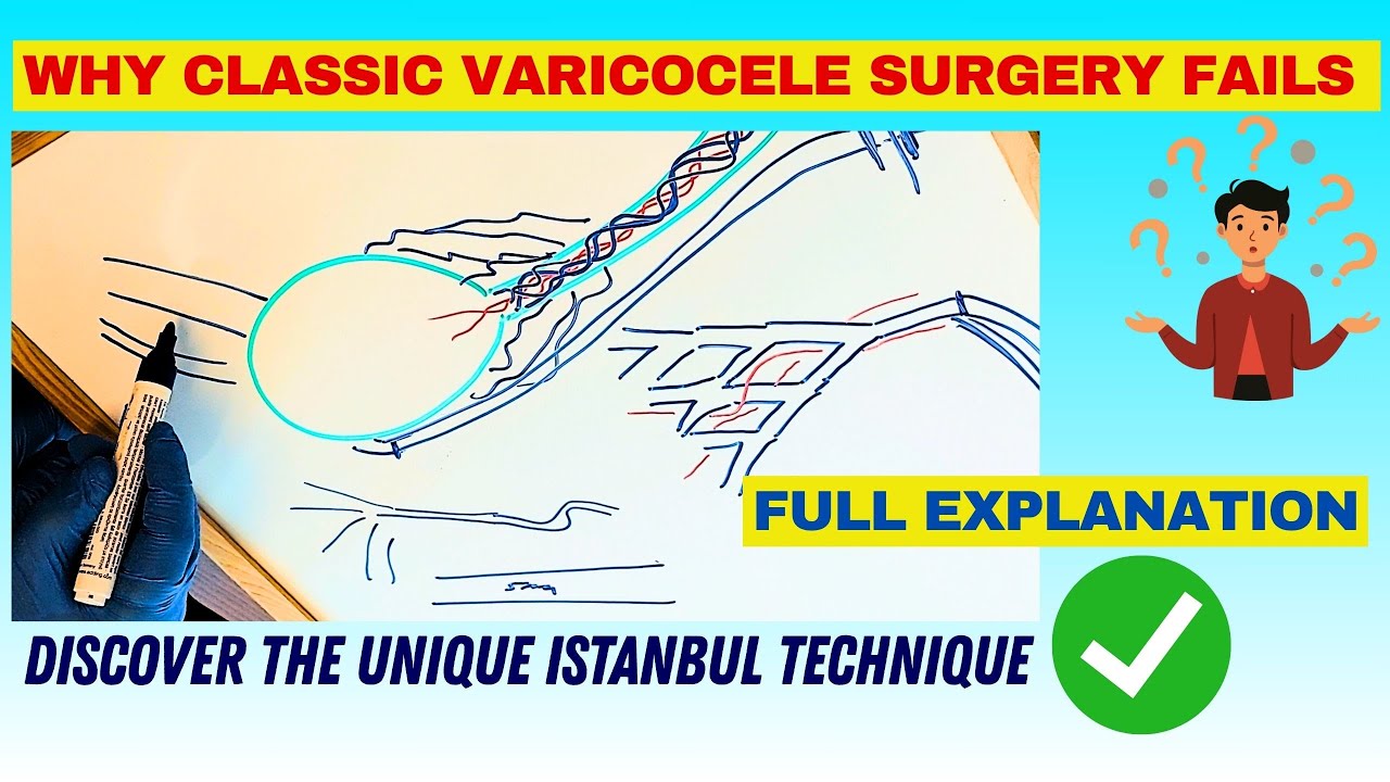 How We Treated Bilateral Varicocele with the Istanbul Technique ? Full Explanation for a UK Patient