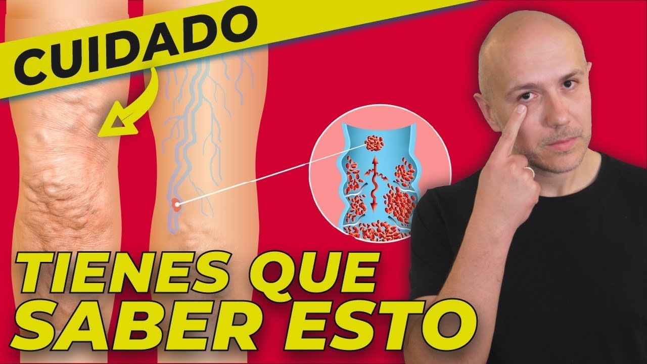 COMBATE LAS VARICES Y LOS TROMBOS EN LAS VENAS | MEJORA LA MALA CIRCULACI&Oacute;N DE LAS PIERNAS