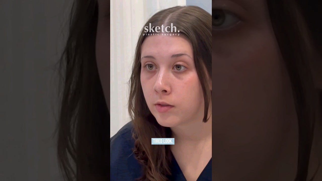 Why Under Eye Fat Repositioning & Fat Grafting? | Sketch Plastic Surgery #koreaplasticsurgery
