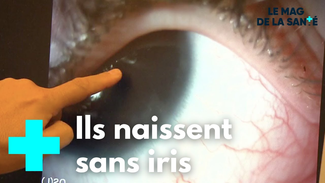 L'aniridie, une maladie de l'oeil très handicapante - Le Magazine de la Santé