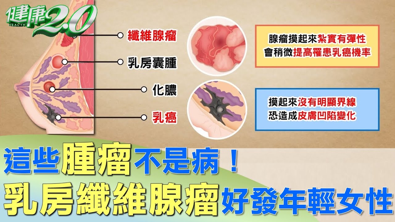 這些腫瘤不是病！乳房纖維腺瘤 好發年輕女性 健康2.0