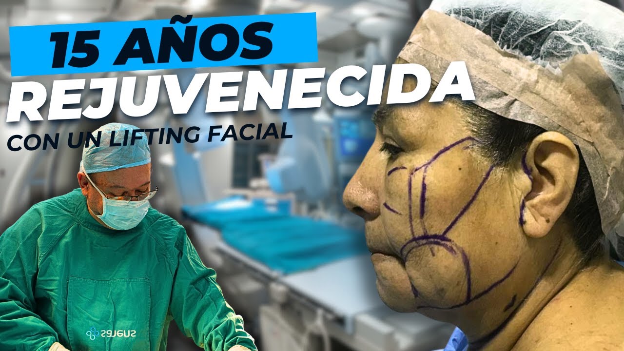 Le QU&Iacute;T&Oacute; 15 A&ntilde;os 🙆&zwj;♀️ REJUVENECIMIENTO o Lifting Facial PER&Uacute; 😍 DR. Alberto Calvo Quiroz