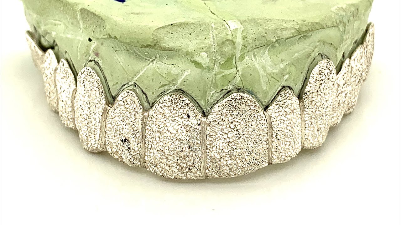 Diamond Dust Grillz Cover Up MISSING TEETH by Seattle Gold Grills!