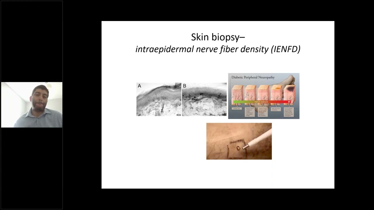 FPN Webinar: Small Fiber Neuropathy with Amro Stino, MD